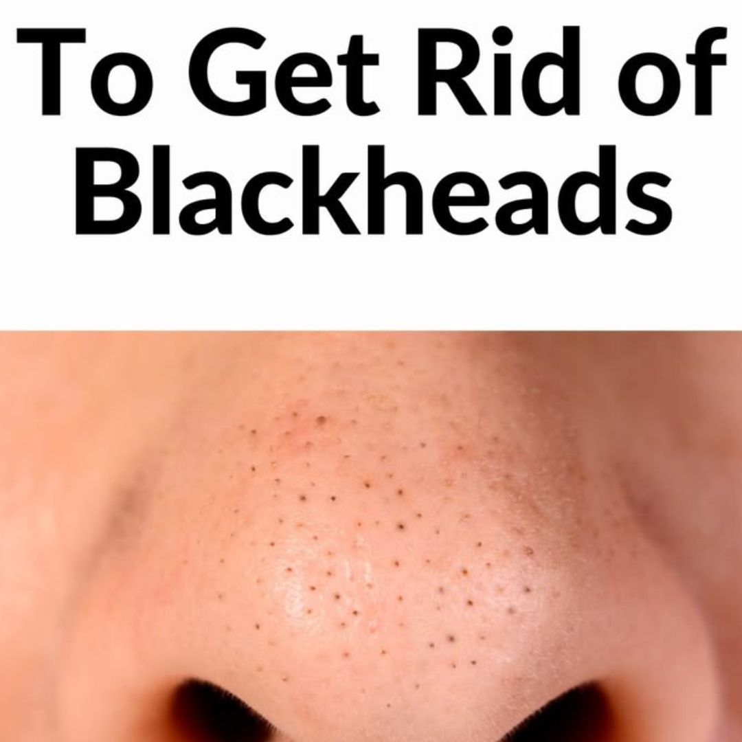 RiRe All Kill Blackhead Remover Stick 10g - Deep Pore Cleansing, Blackhead & Whitehead Exfoliating Balm